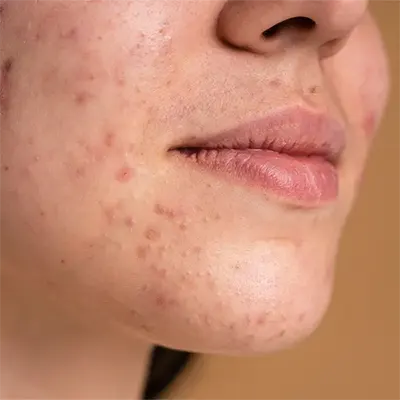 img-tratamiento para el acne bogota-1-moviñ