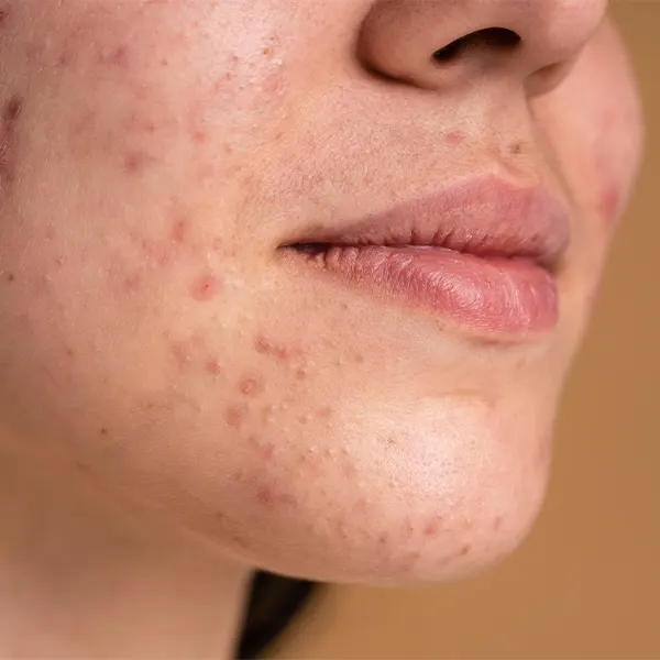 img-tratamiento para el acne bogota-1